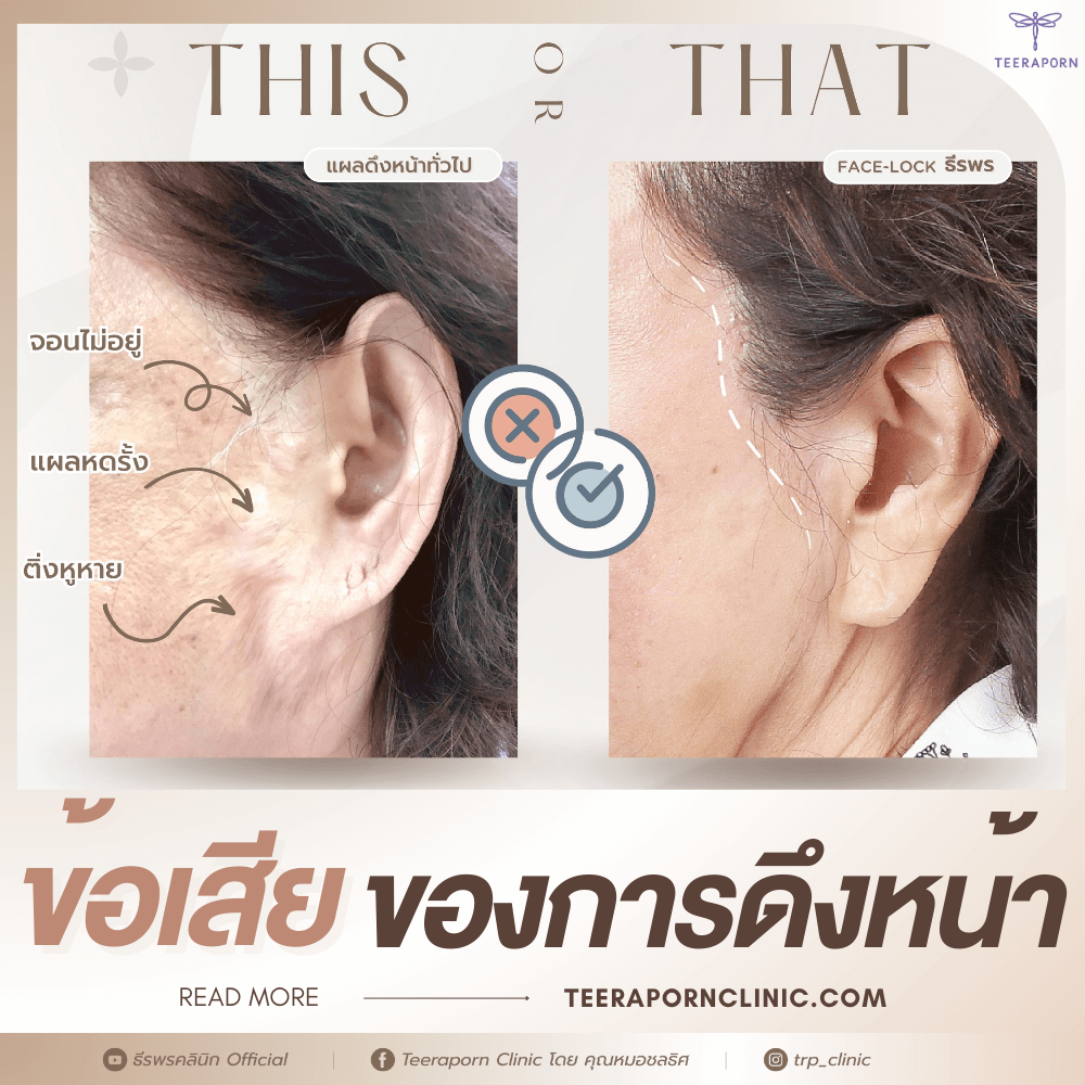 ข้อเสีย ของการดึงหน้า