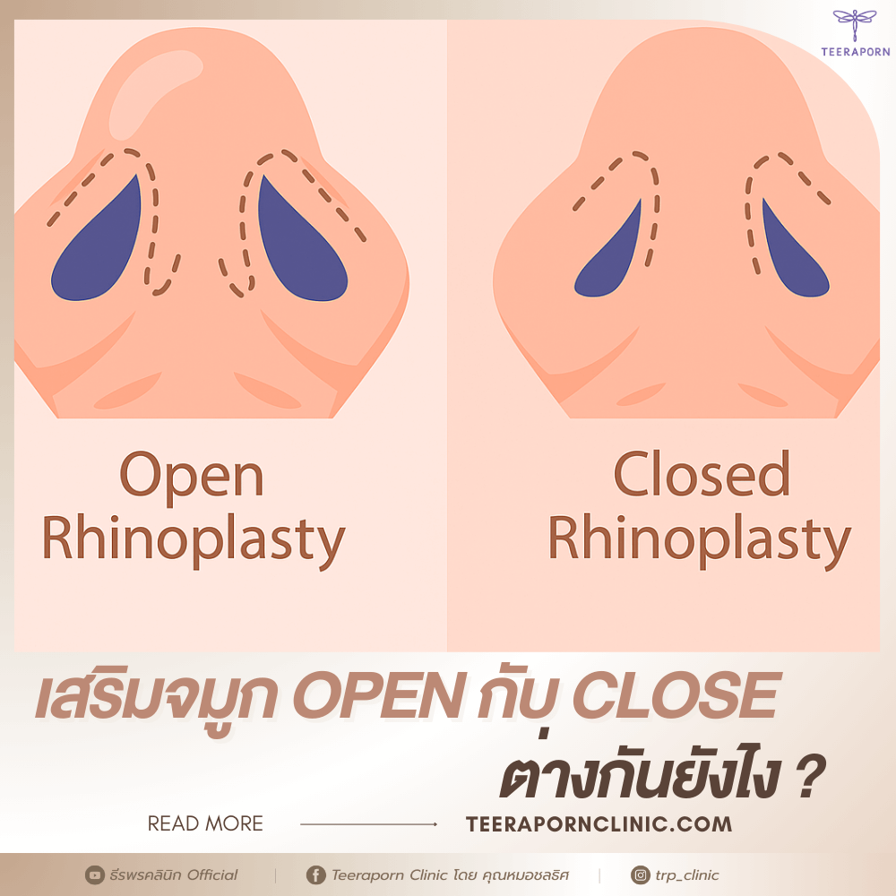 เสริมจมูก open กับ close ต่างกันยังไง