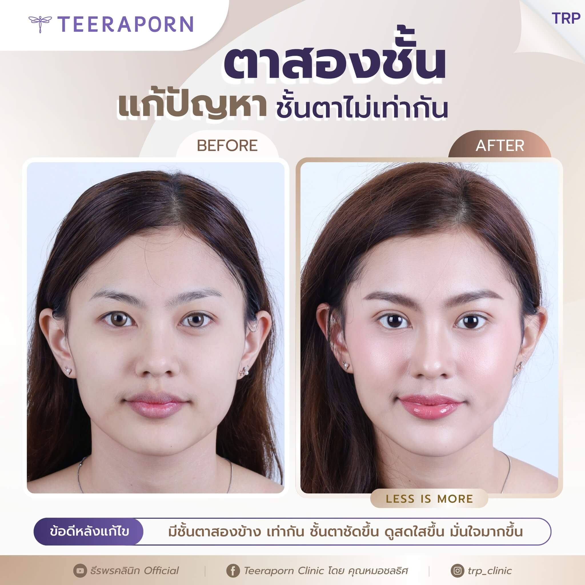 ตาไม่เท่ากัน วิธีแก้