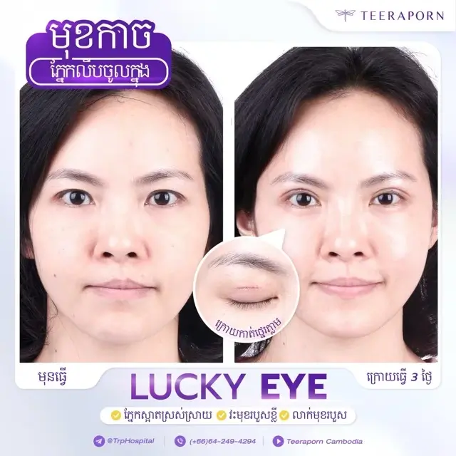 Lucky eyes
