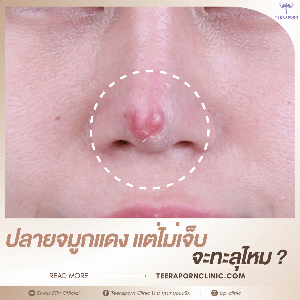 ปลายจมูกแดง แต่ไม่เจ็บ