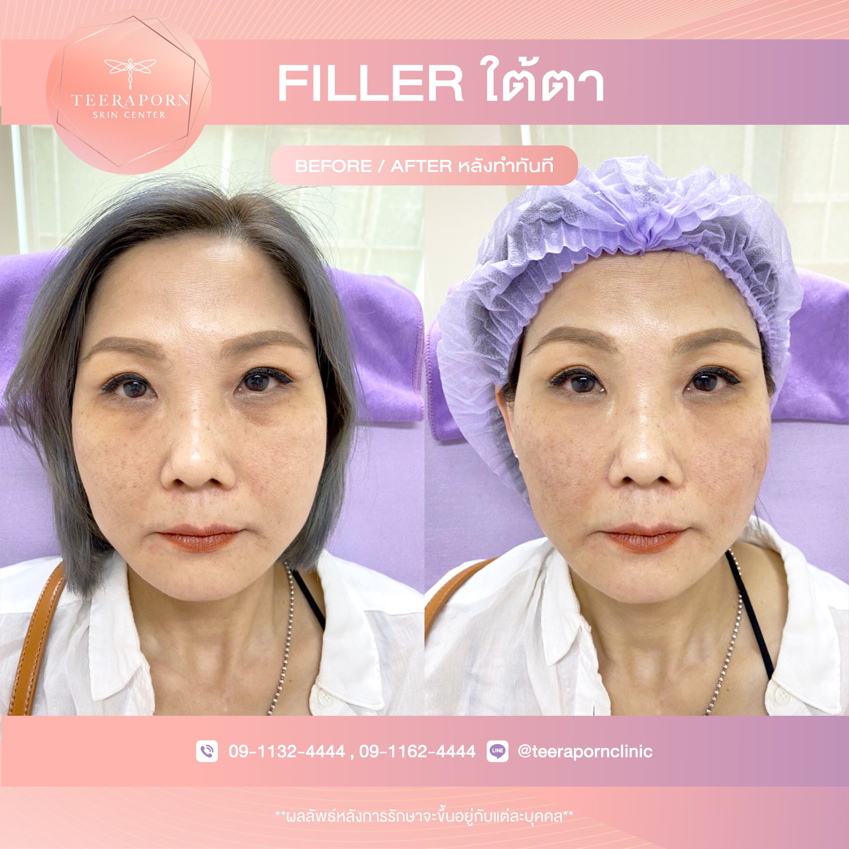 filler ใต้ตา