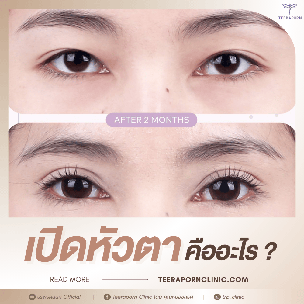 เปิดหัวตา คืออะไร