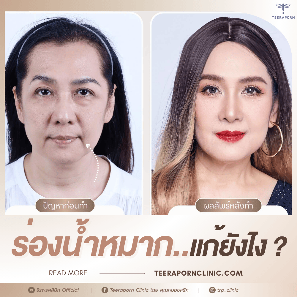 ร่องน้ำหมาก