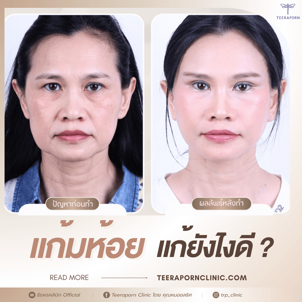 แก้มห้อย