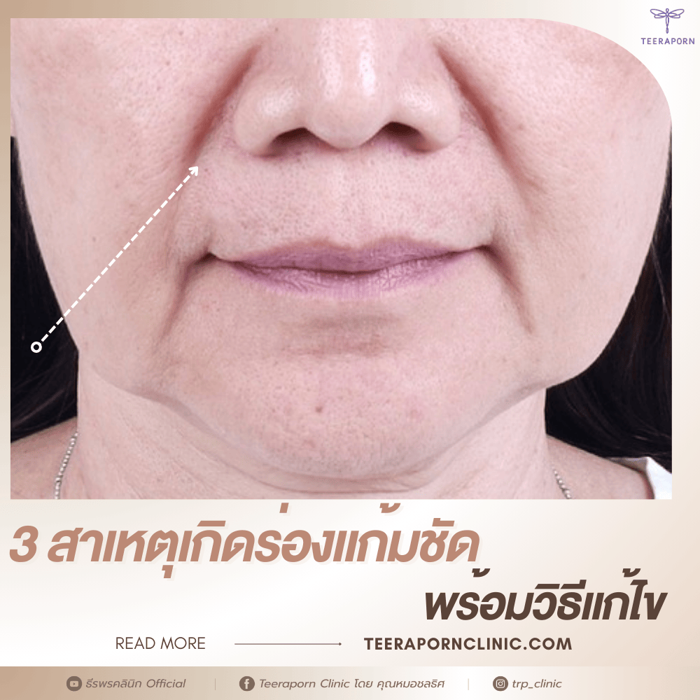 ร่องแก้มชัด