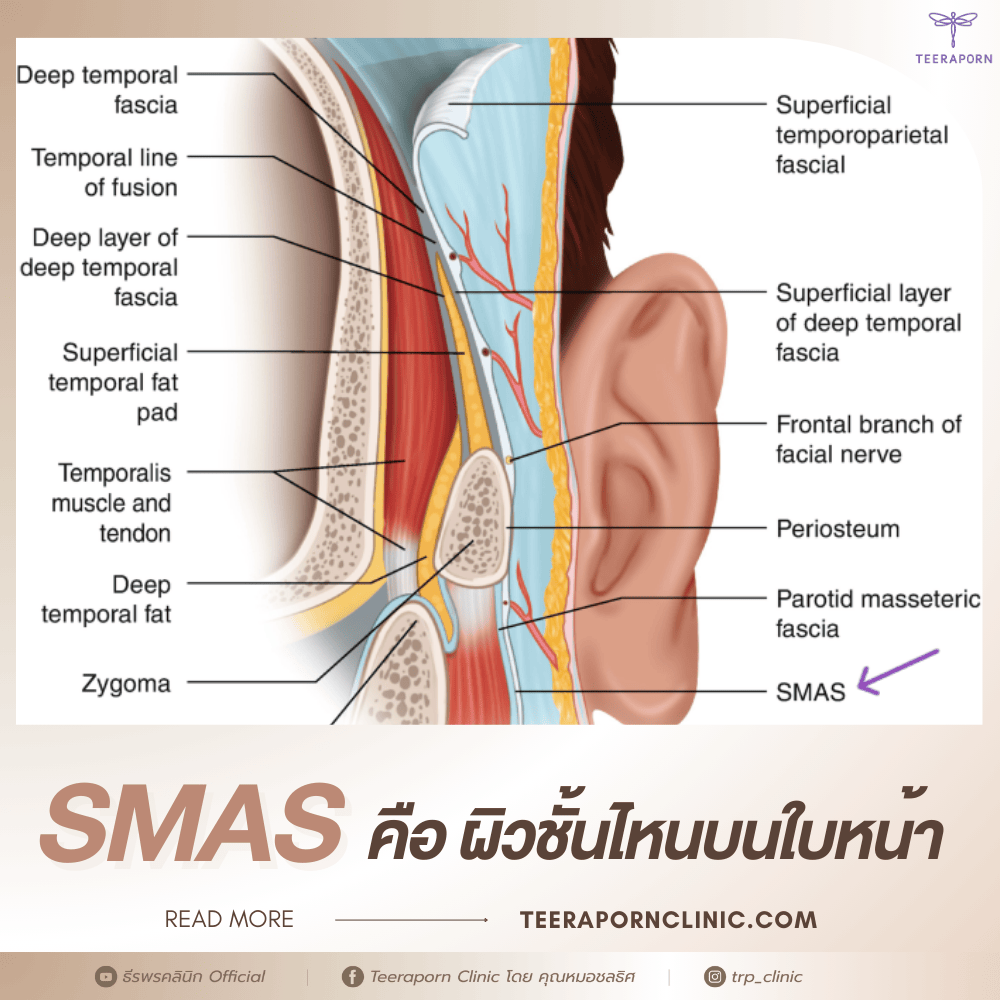smas