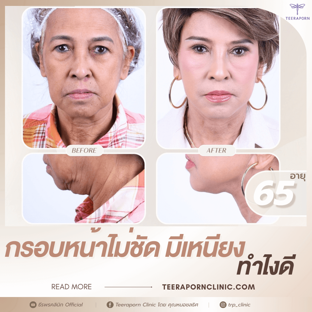 กรอบหน้าไม่ชัด