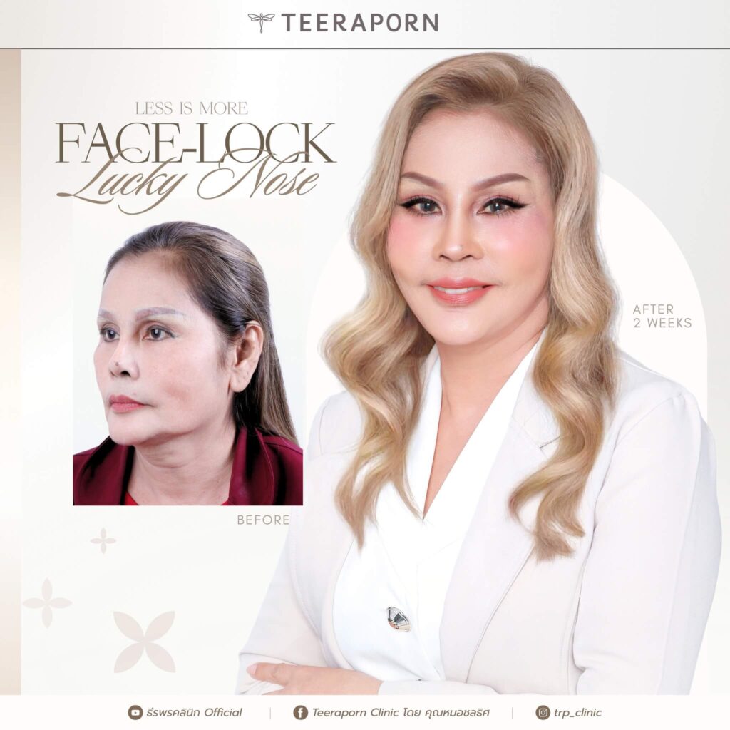 รีวิวดึงหน้า + เสริมจมูก คุณจิน