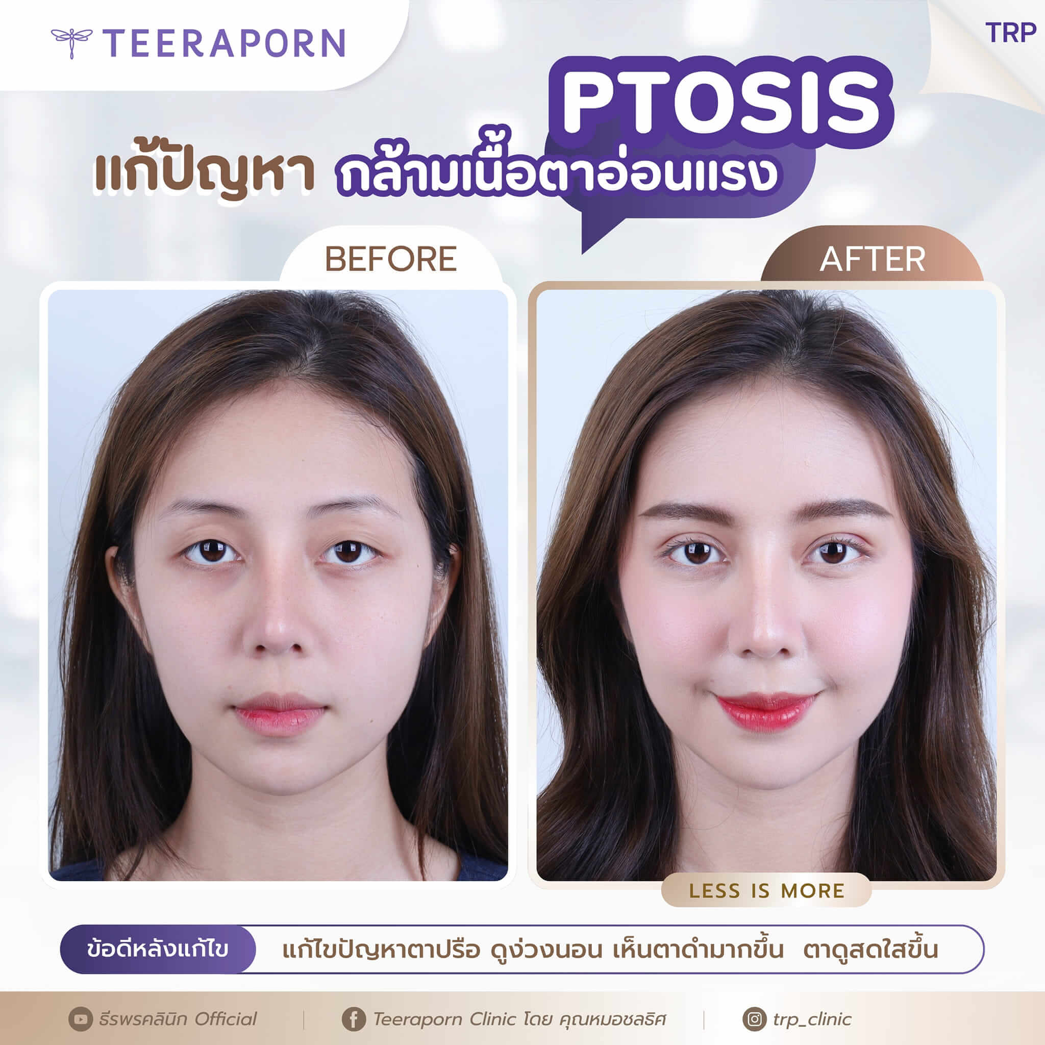 กล้ามเนื้อตาอ่อนแรง 16 ตาล้า ง่วง ตลอดเวลา