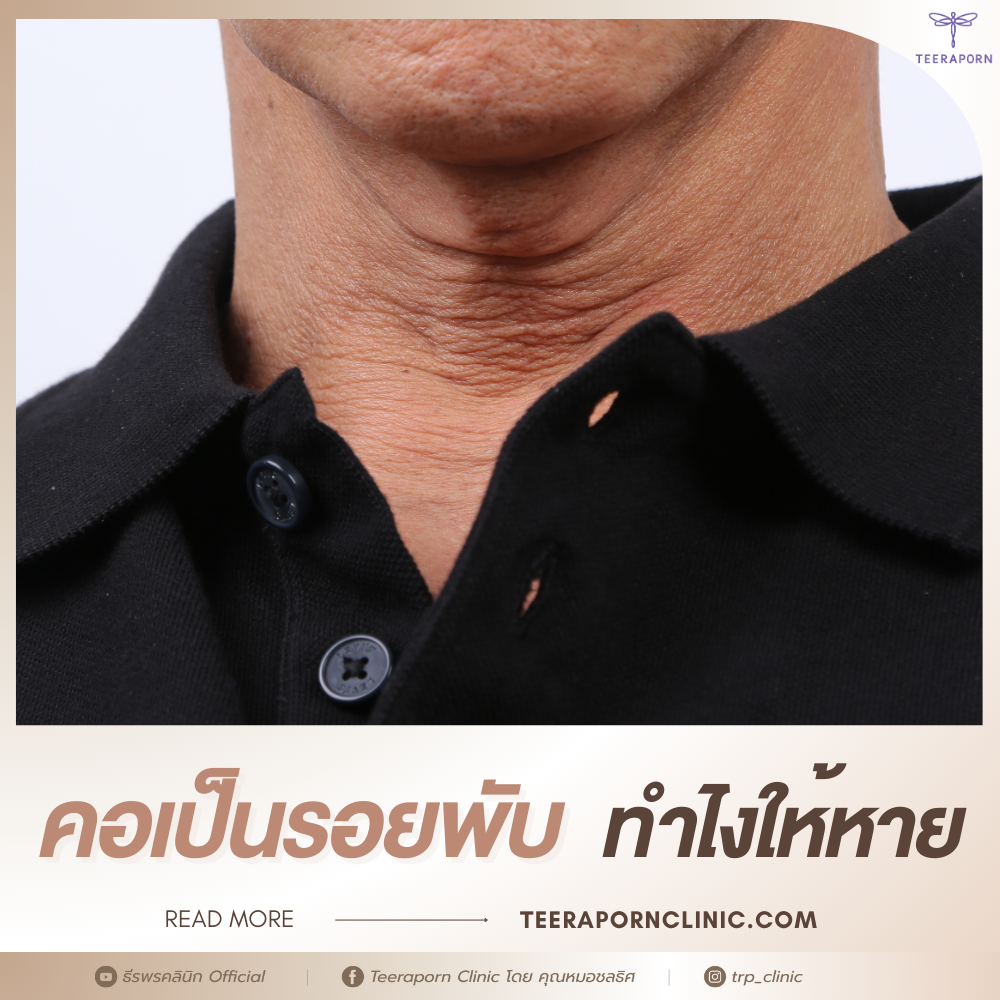 คอเป็นรอยพับ
