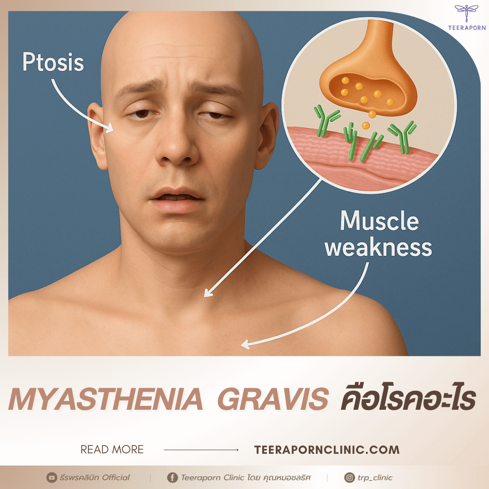 myasthenia gravis