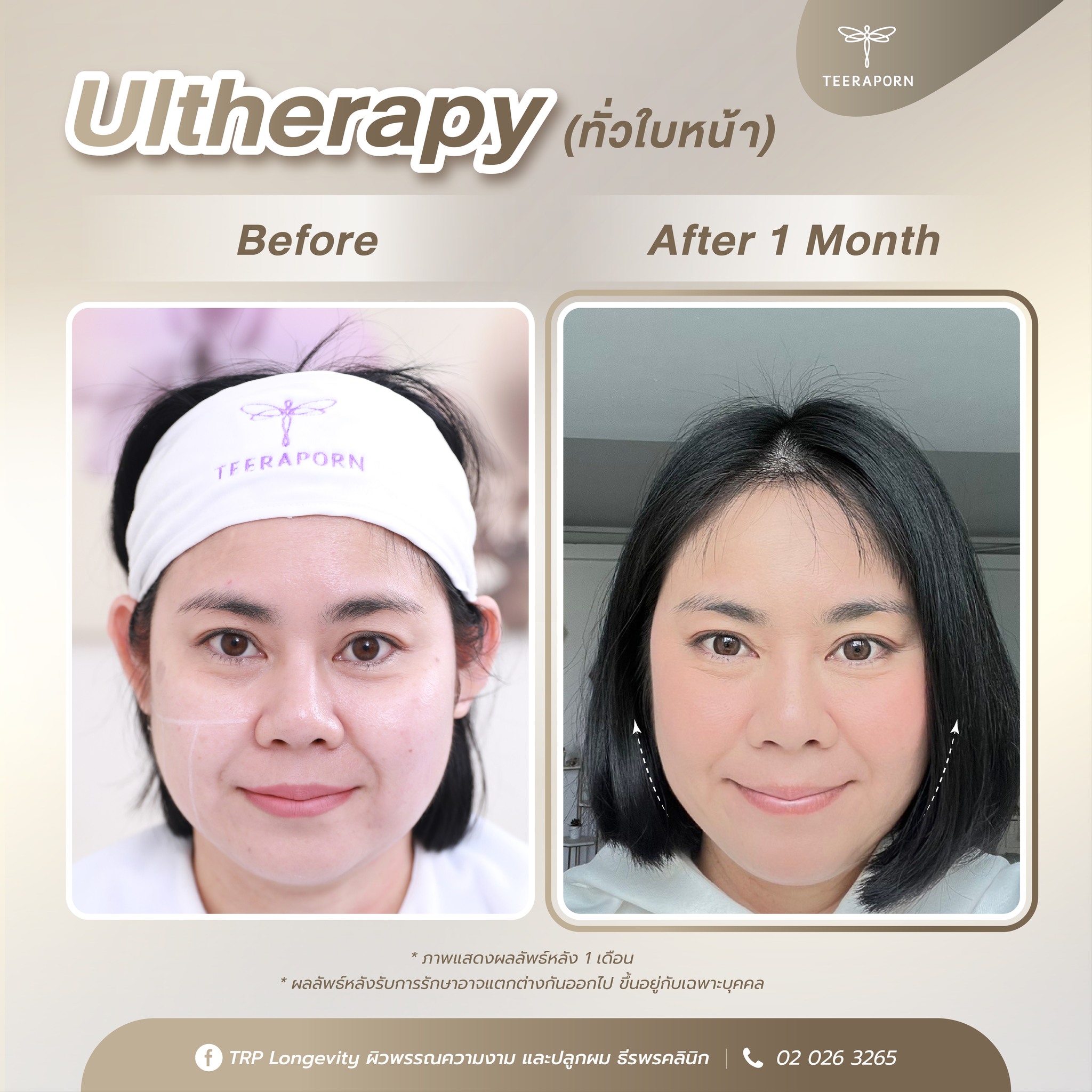 รีวิวทำ Ulthera คุณโย 1