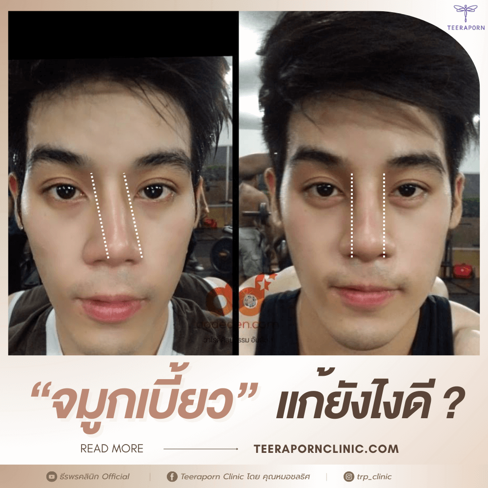 จมูกเบี้ยว