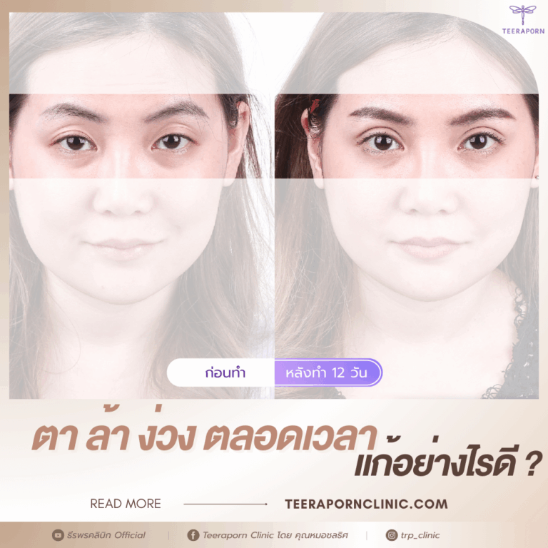 ตาล้า ง่วง ตลอดเวลา