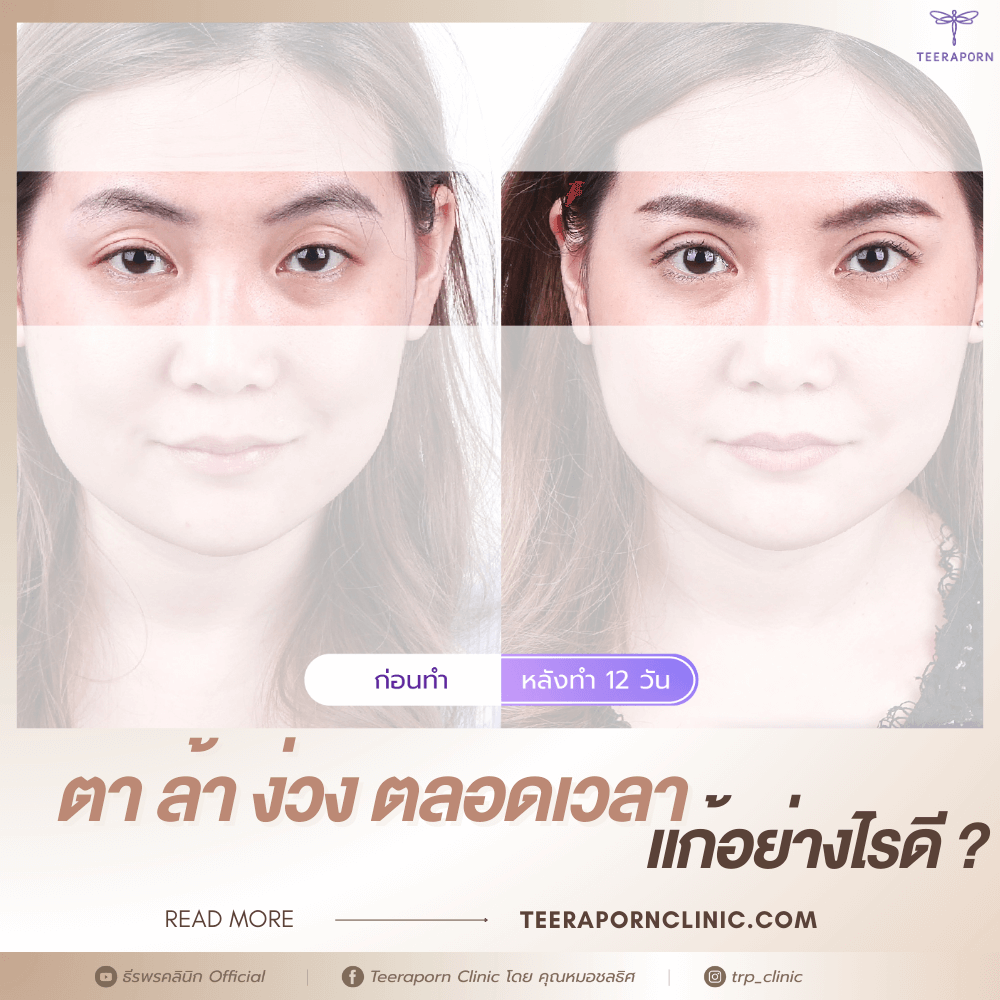 ตาล้า ง่วง ตลอดเวลา