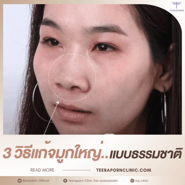 แก้จมูกใหญ่ ธรรมชาติ