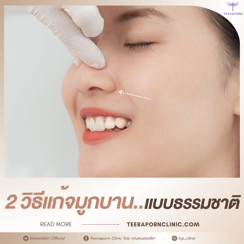 แก้จมูกบาน ธรรมชาติ