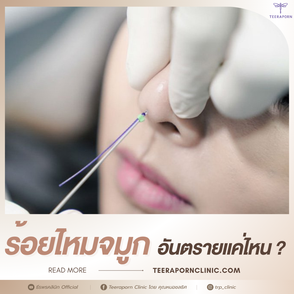 ร้อยไหมจมูก