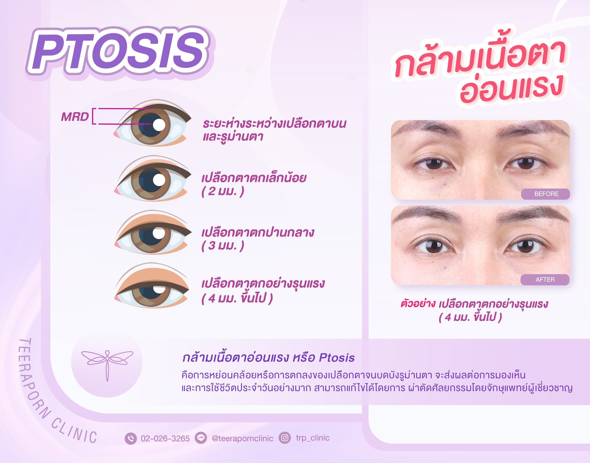 PTOSIS คือ 1 ptosis