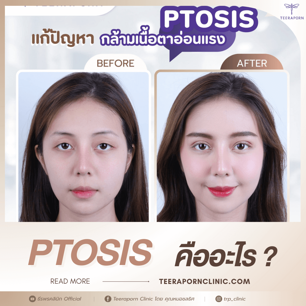 ptosis คือ