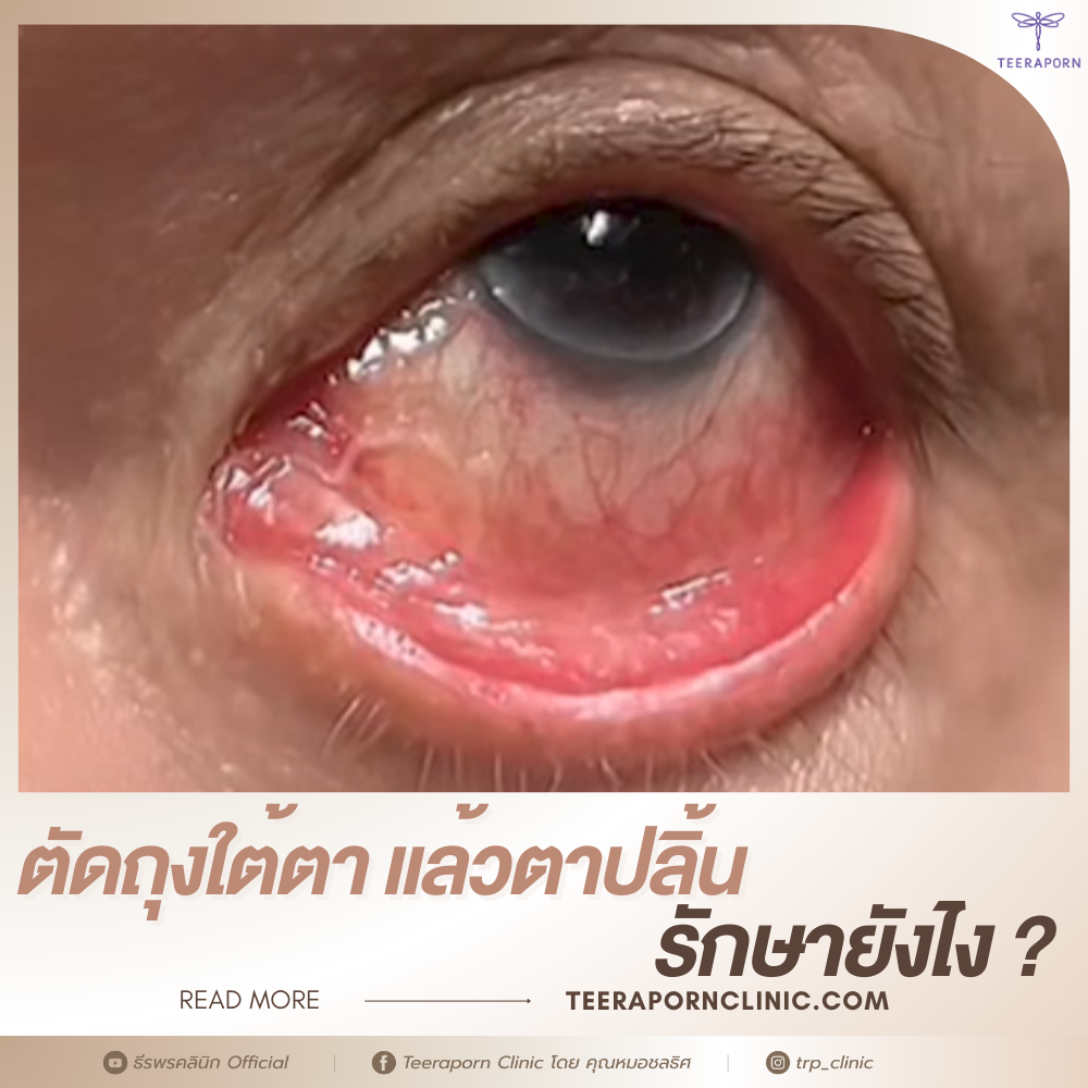 ตัดถุงใต้ตา ตาปลิ้น
