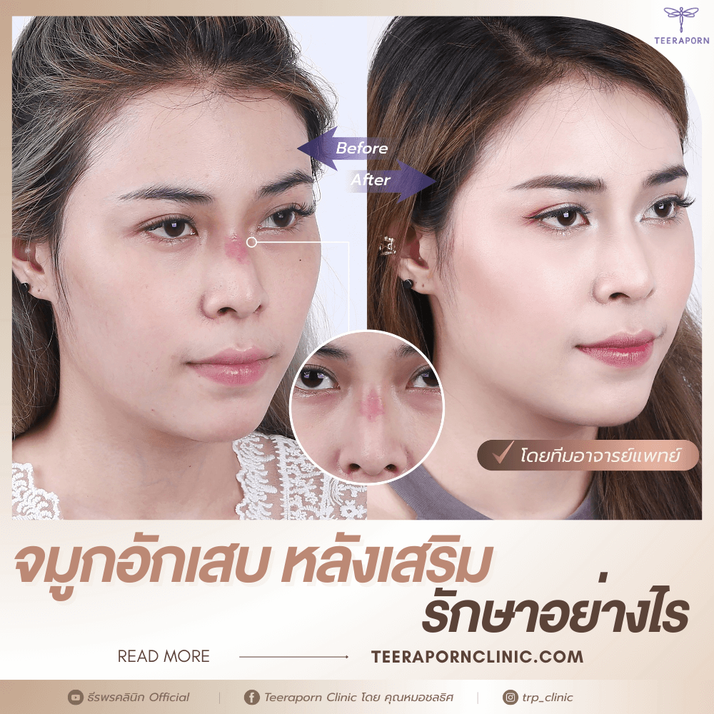 จมูกอักเสบ
