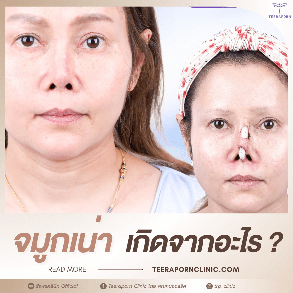 จมูกเน่า