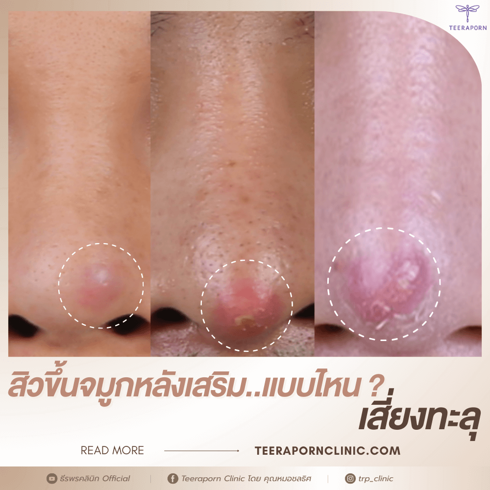 สิวขึ้นจมูก