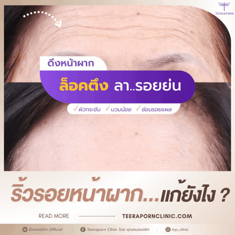 ริ้วรอยหน้าผาก