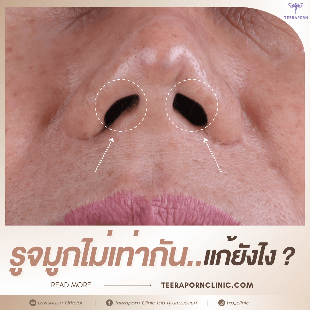 รูจมูกไม่เท่ากัน