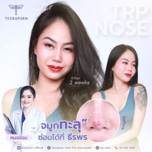 รูจมูกไม่เท่ากัน 3