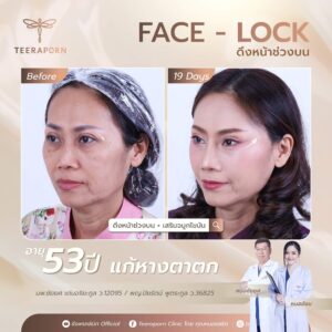 รีวิวเสริมจมูกไขมัน