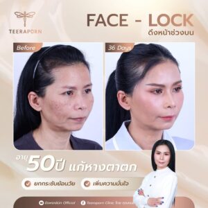ดึงหน้า คุณออม