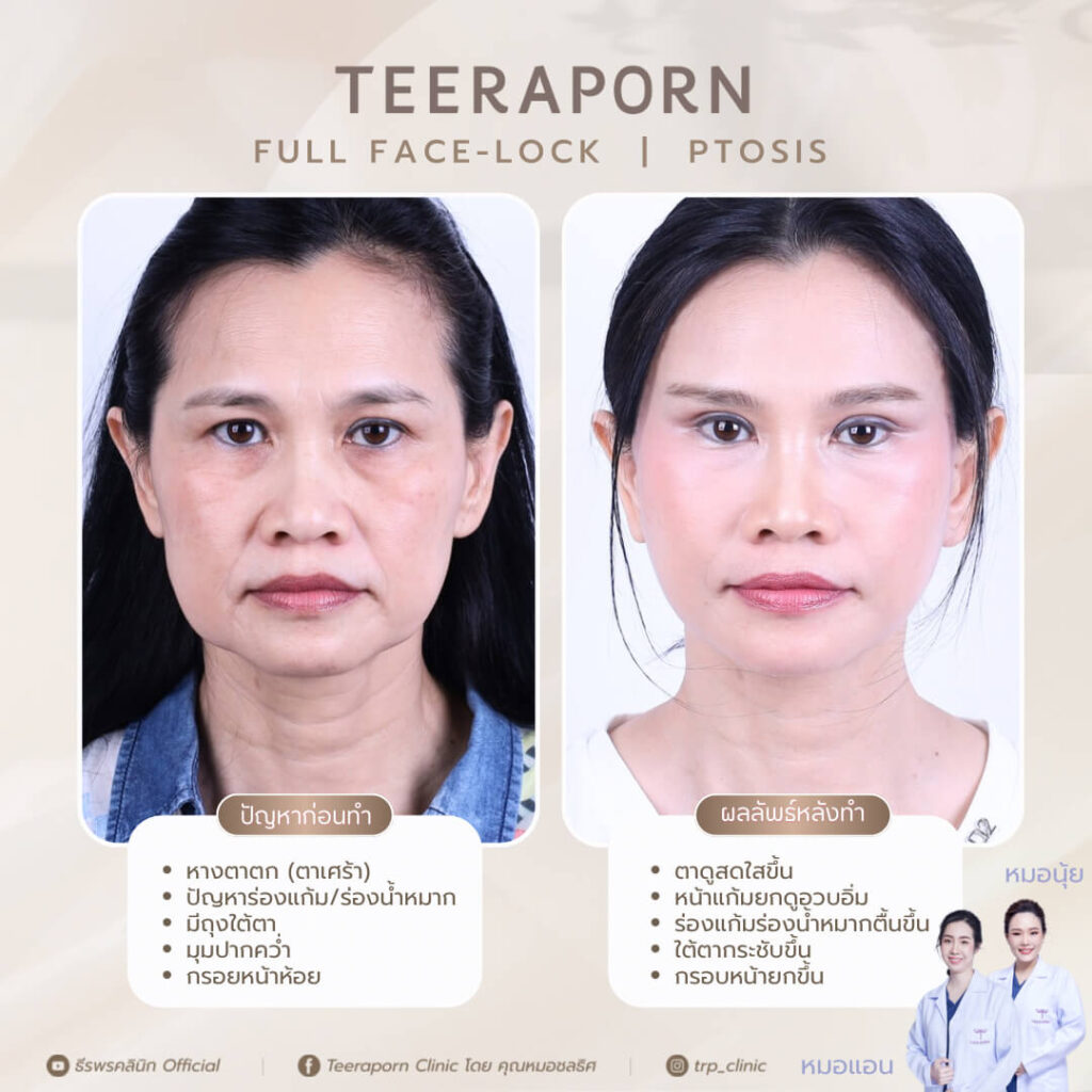 รีวิวดึงหน้า กล้ามเนื้อตาอ่อนแรง
