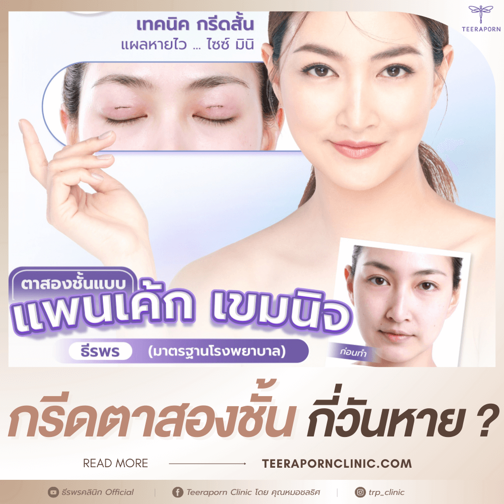 กรีดตาสองชั้น
