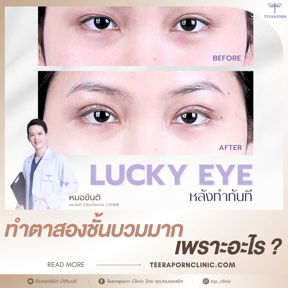 ทําตาสองชั้น บวมนาน