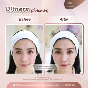 รีวิวทำ Ultherapy คุณแอน ทวีรัตน์ จิรดิลก
