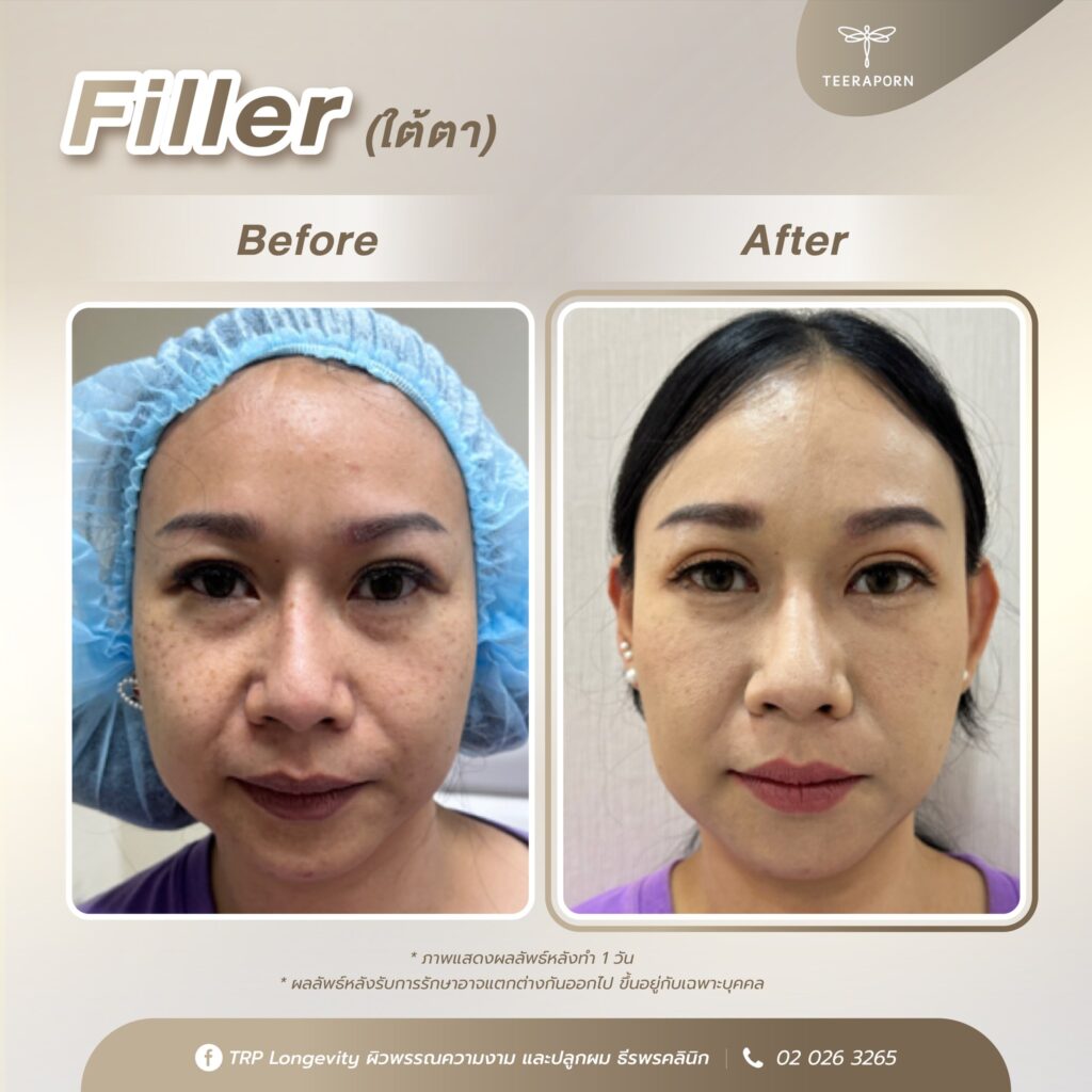 รีวิวฉีด Filler ใต้ตา คุณนิดหน่อย