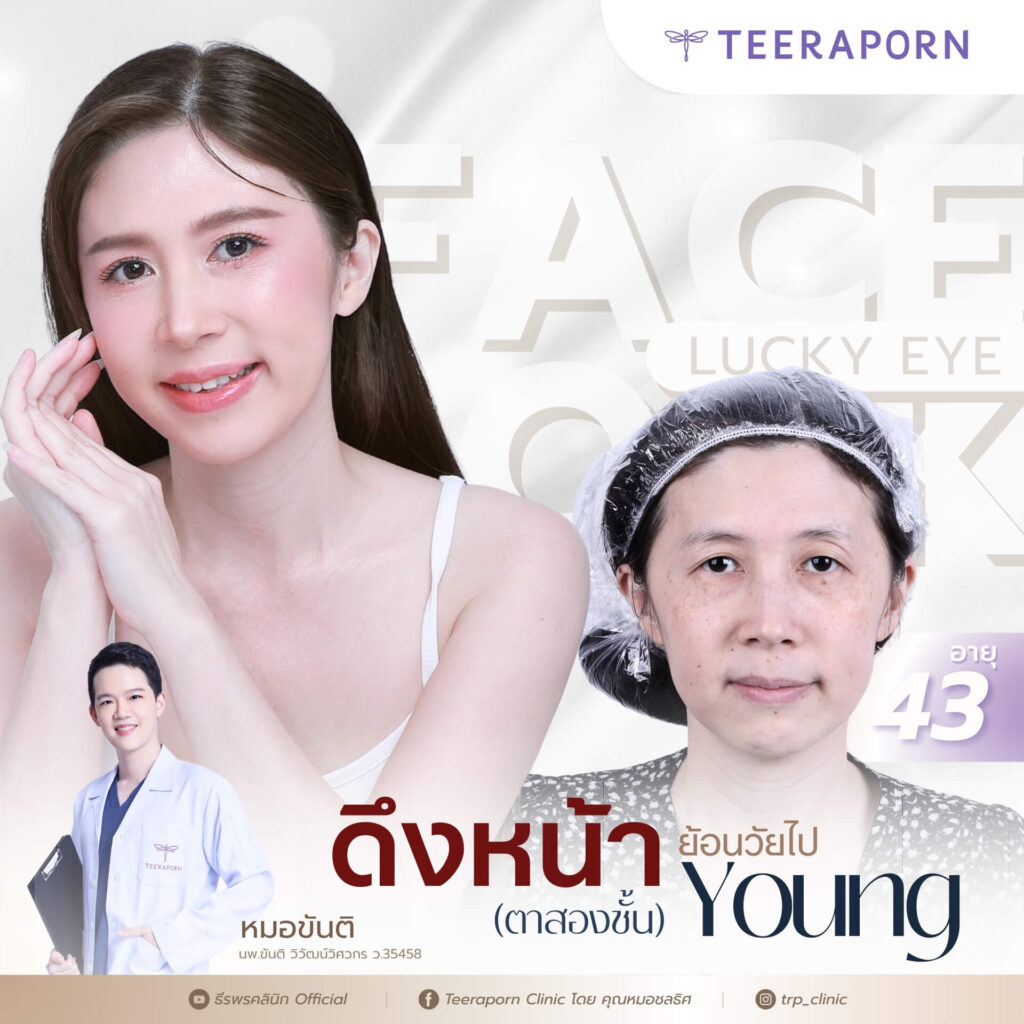 รีวิวดึงหน้า คุณซิว