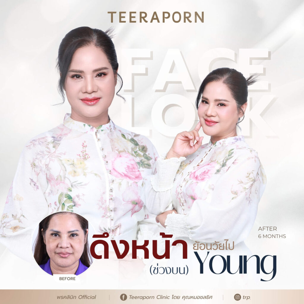 รีวิวดึงหน้า Face Lock คุณเล็ก