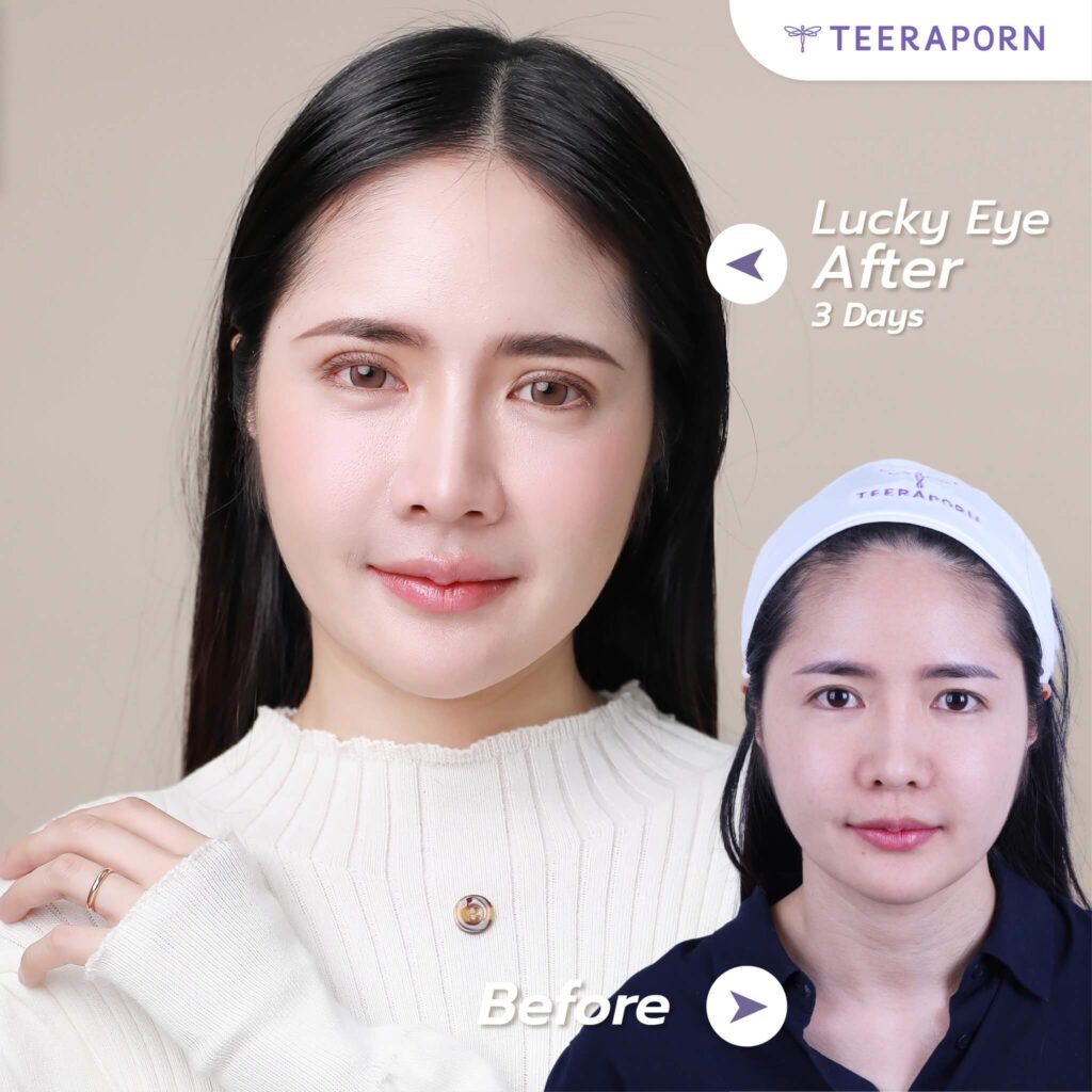 รีวิวทำตาสองชั้นคุณเทียน