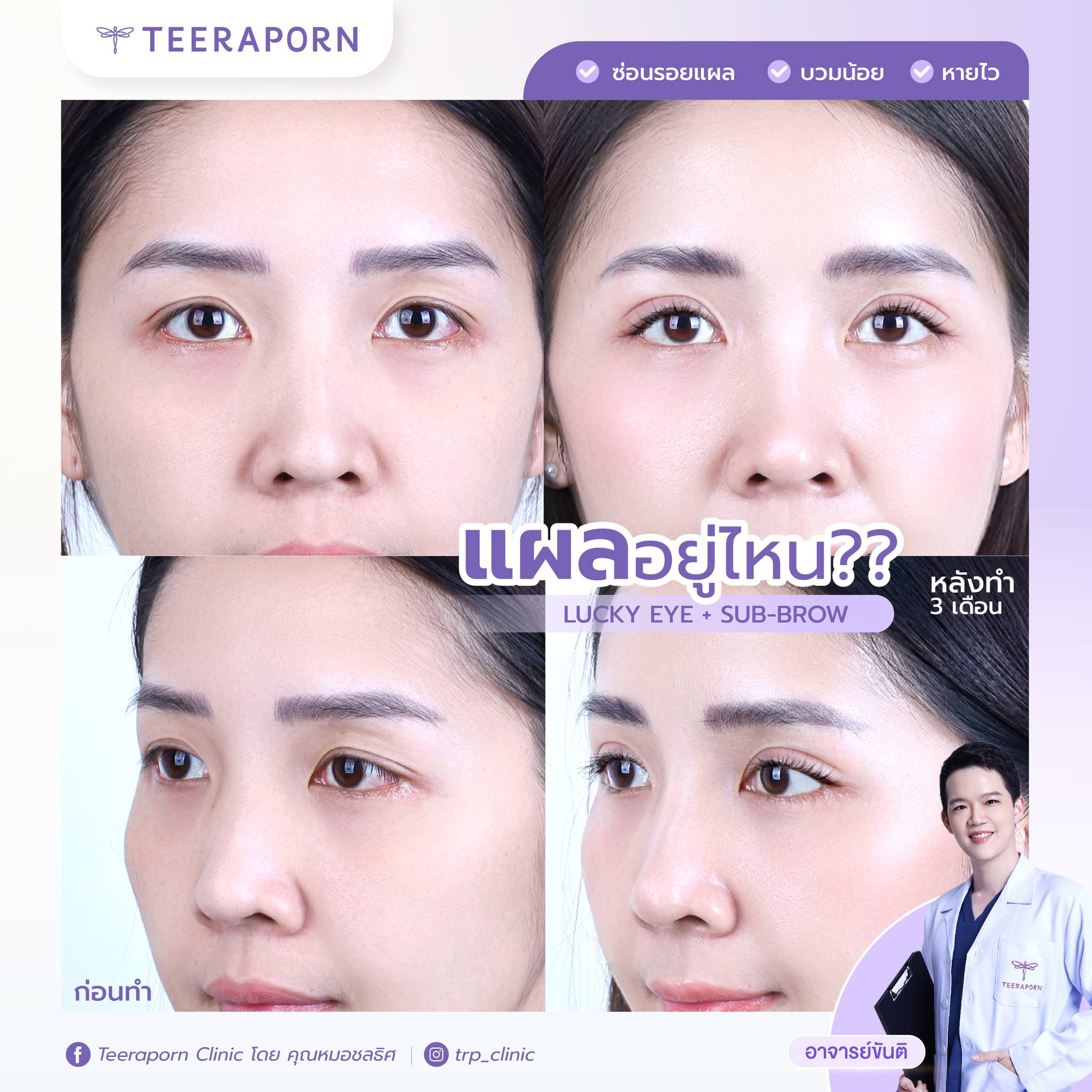 Subbrow Lift 3 subbrow lift หมอไหนดี