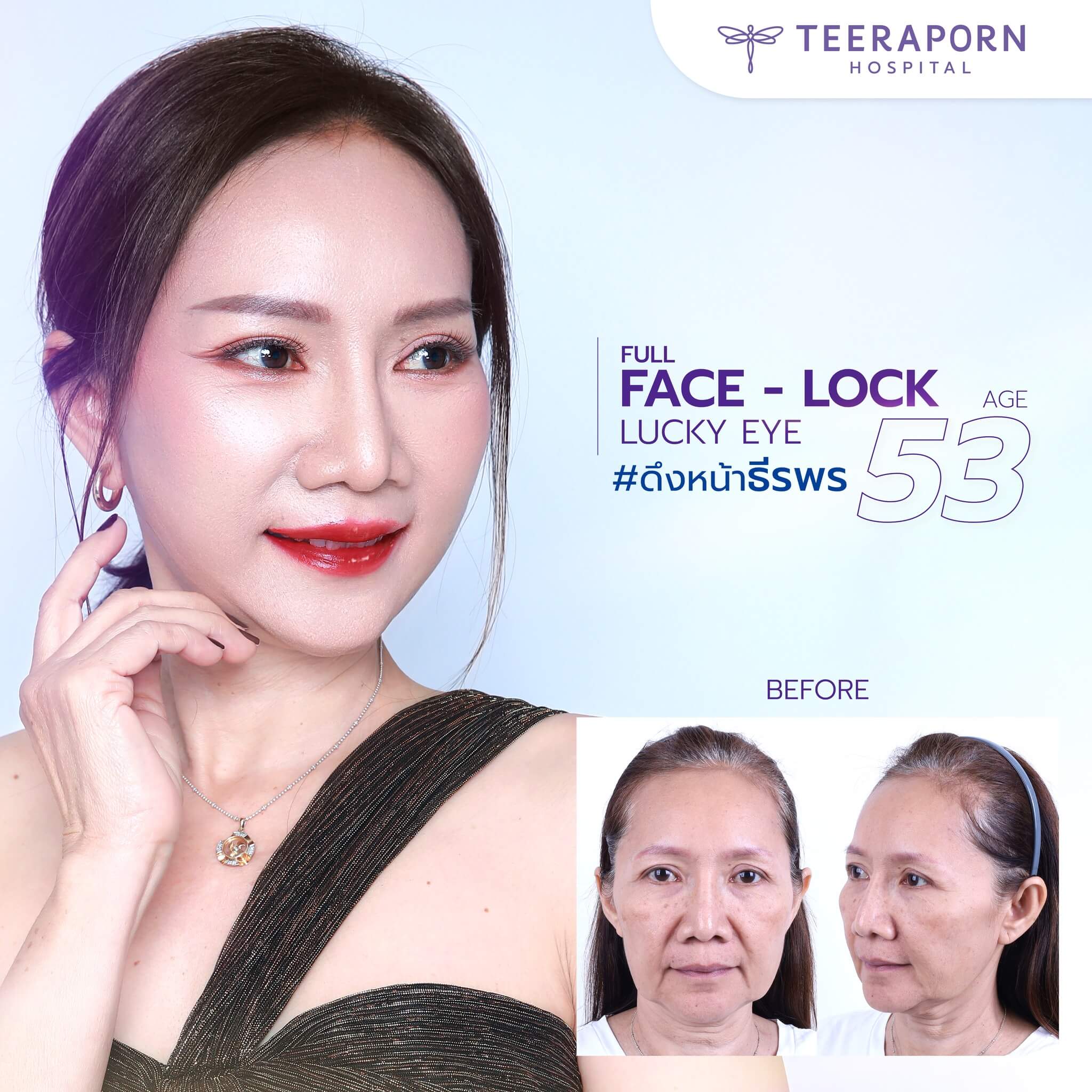 ดึงหน้า เลอลักษณ์ ราคา