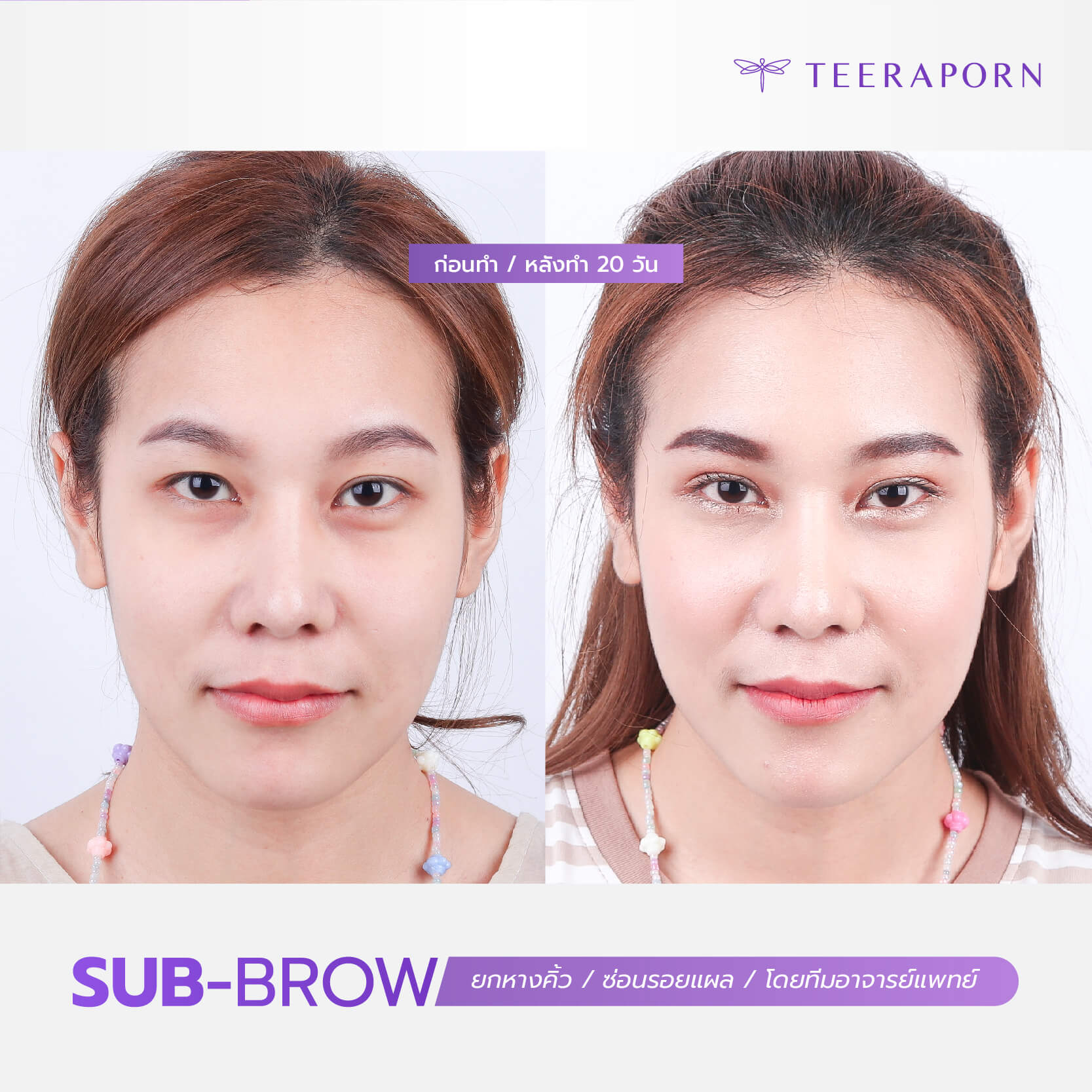 Subbrow Lift 4 subbrow lift หมอ เฟิร์น pantip