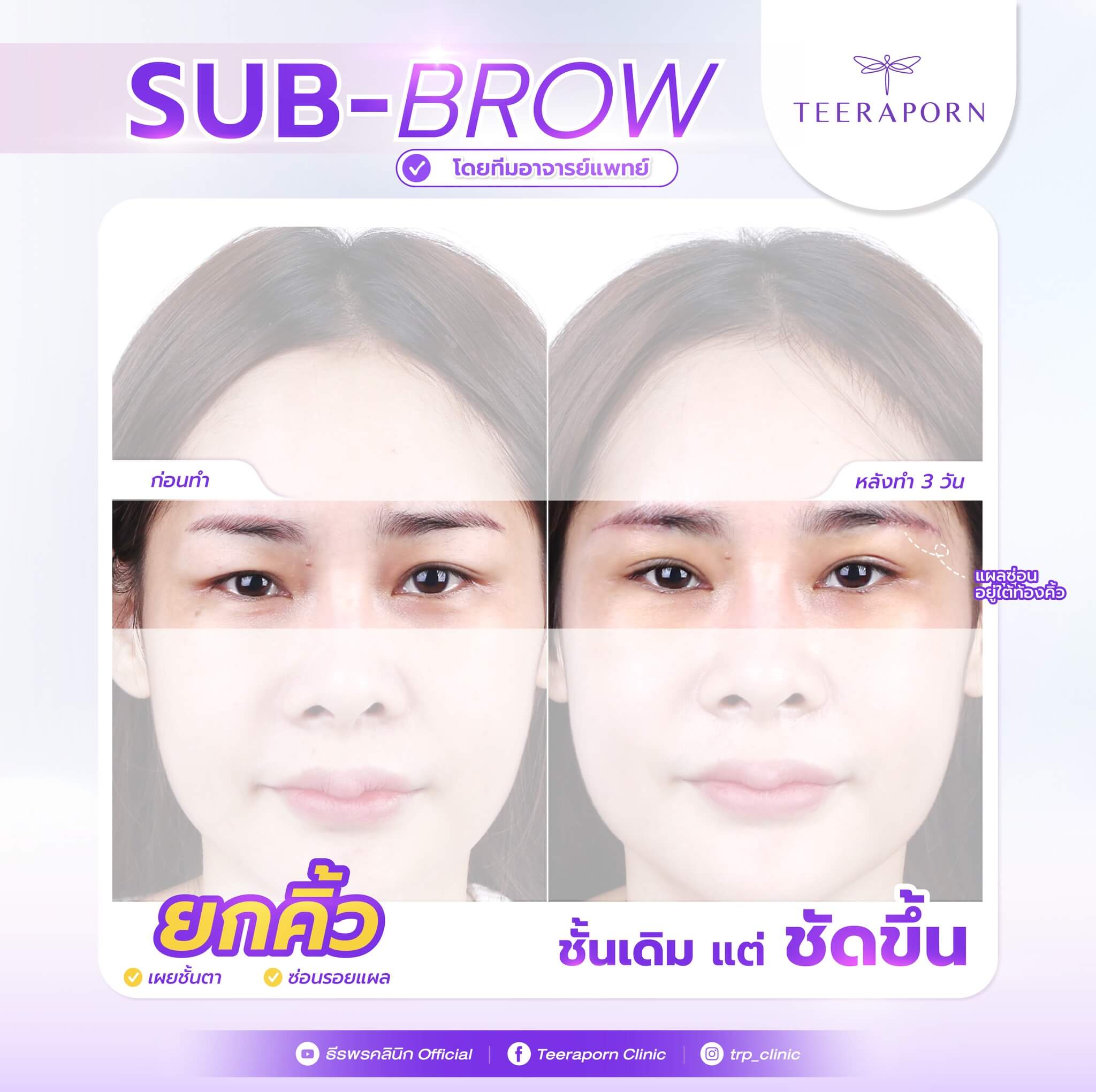 Subbrow Lift 5 subbrow lift หมอ เฟิร์น ราคา