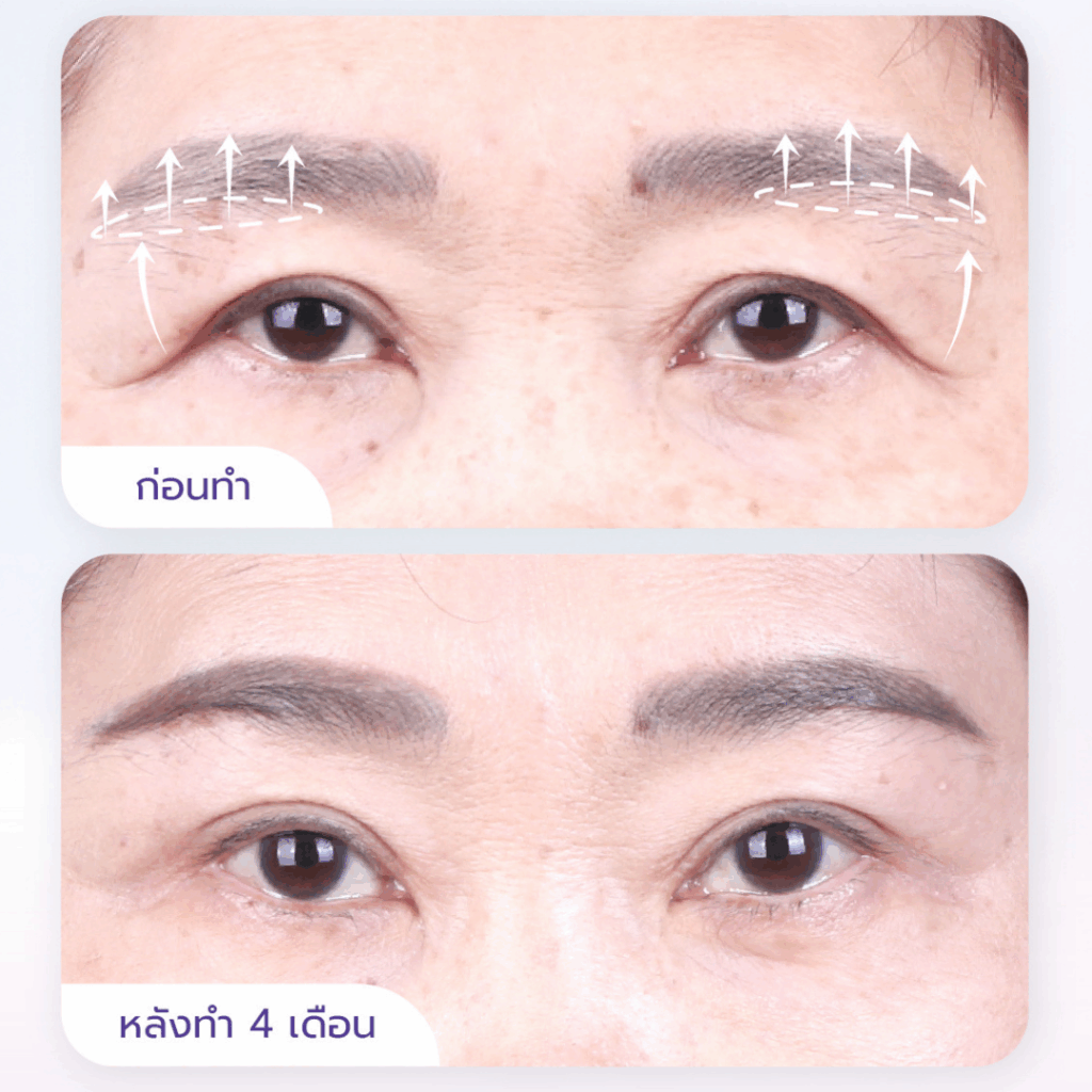 subbrow lift
