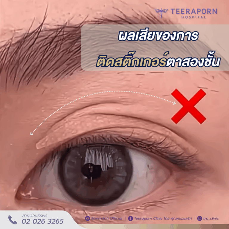 สติ๊กเกอร์ตาสองชั้น